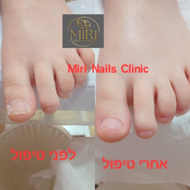 תוצאת טיפול בקליניקה — לפני ואחרי