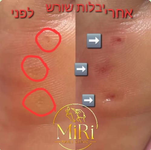תוצאת טיפול בקליניקה — לפני ואחרי