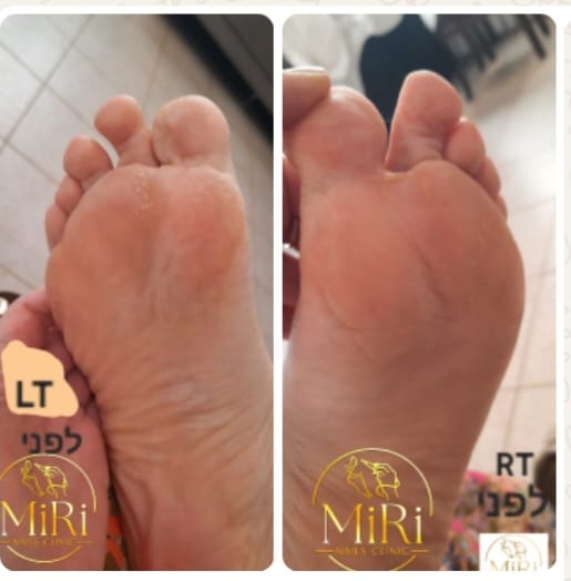 תוצאת טיפול בקליניקה — לפני ואחרי