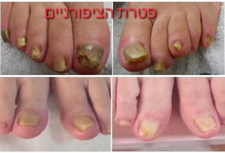 תוצאת טיפול בקליניקה — לפני ואחרי